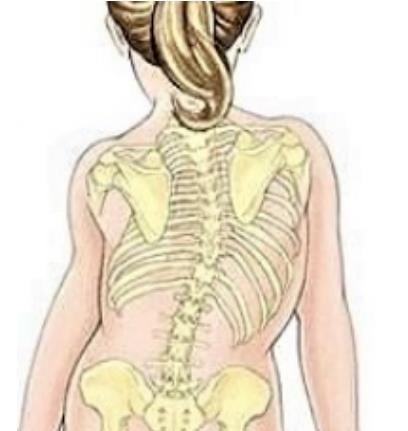 脊柱側(cè)彎矯形器(支具)