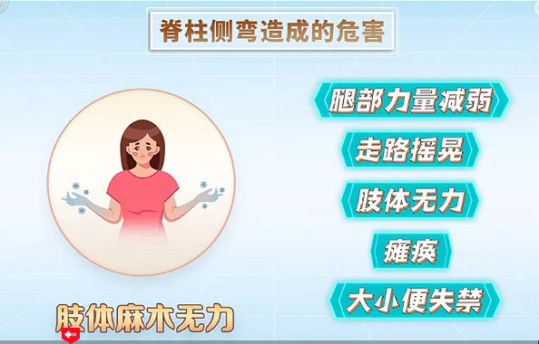 脊柱側(cè)彎造成的危害