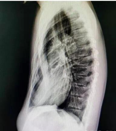 漏斗胸怎么矯正？