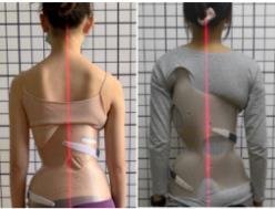 脊柱側彎矯形器(支具)  