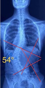 睡姿對(duì)脊柱側(cè)彎患者的影響